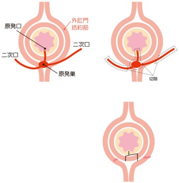 瘻管切開開放術