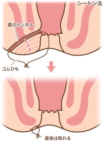 シートン法