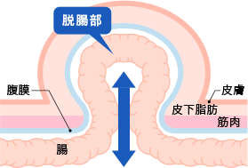 脱腸と鼠径ヘルニアは同じなの