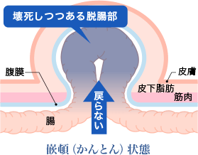 鼠経ヘルニアを放置していると危険です