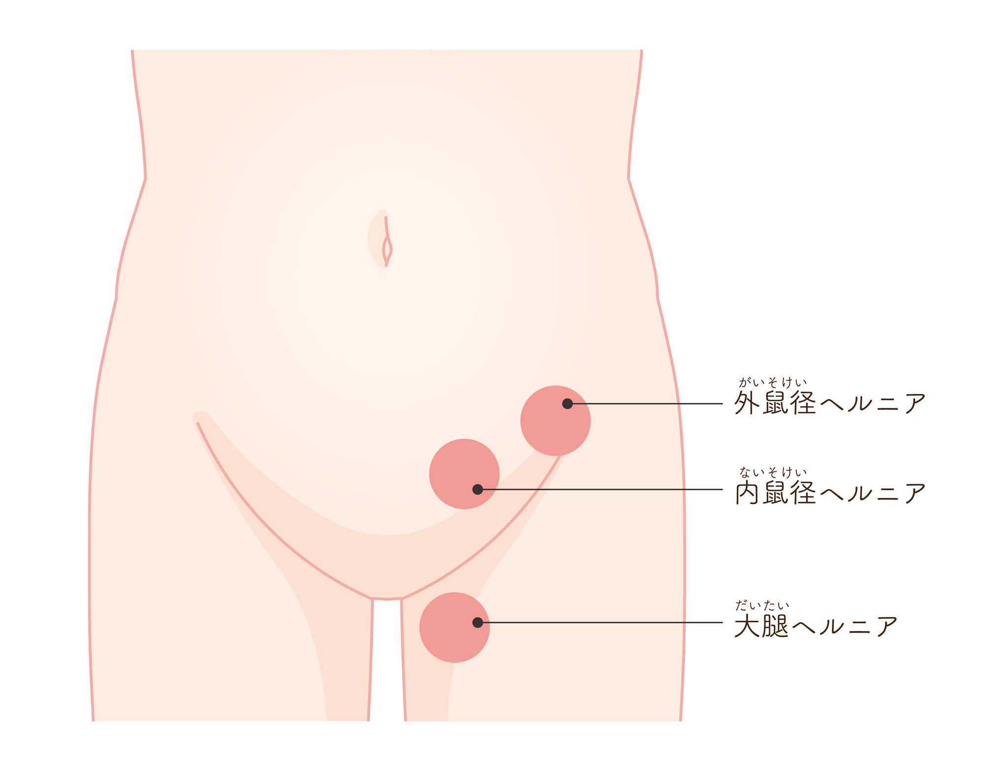 鼠径ヘルニアの症状と検査