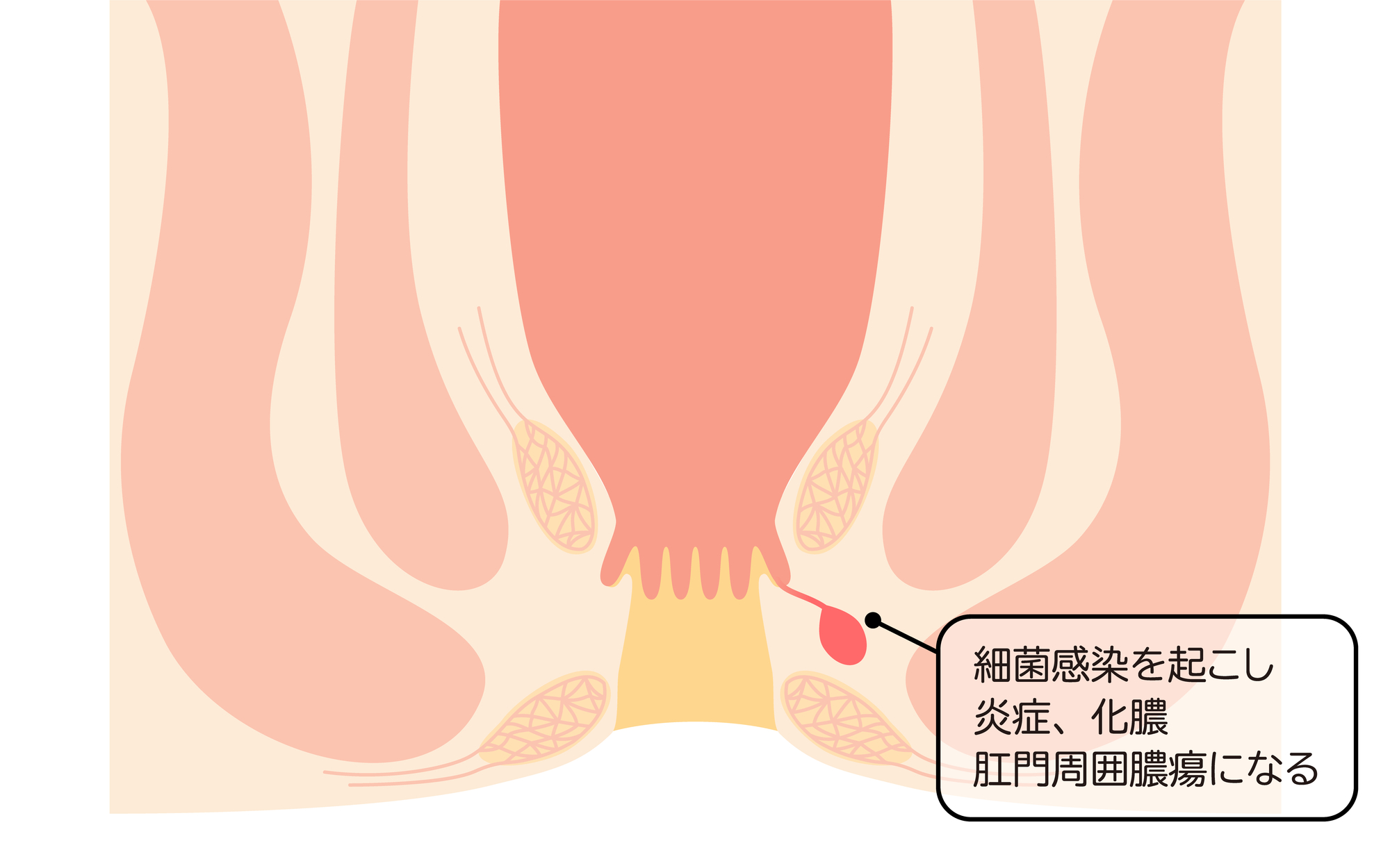 肛門周囲膿瘍について