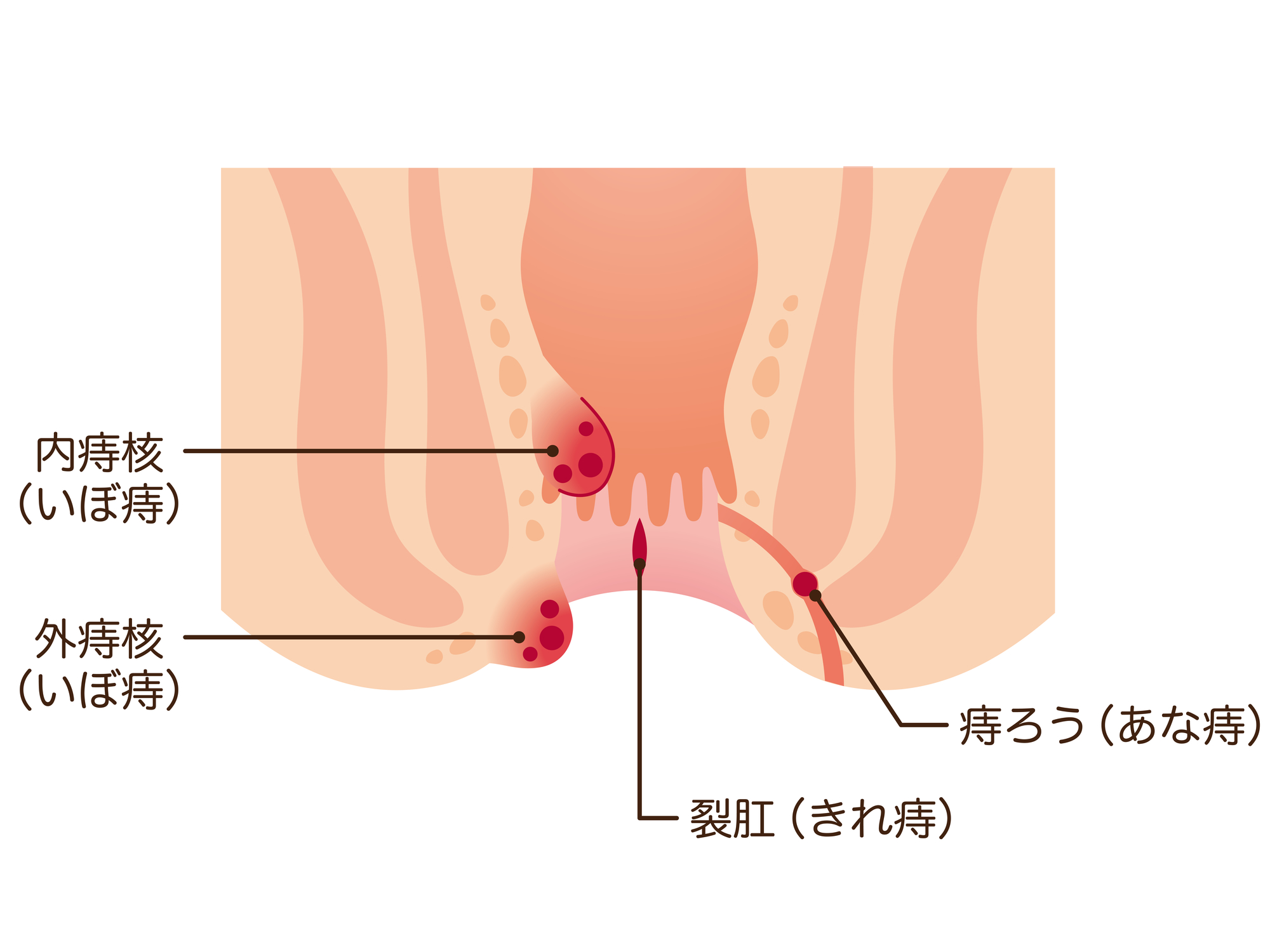 肛門疾患の種類