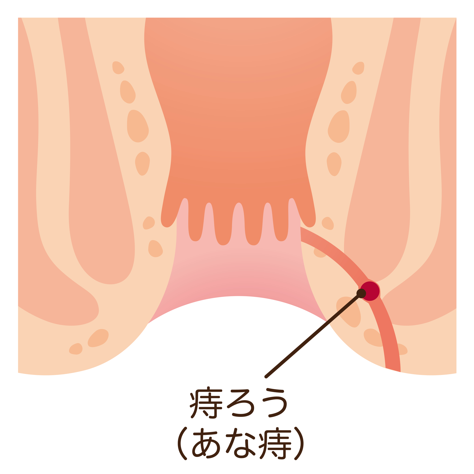 痔ろうについて