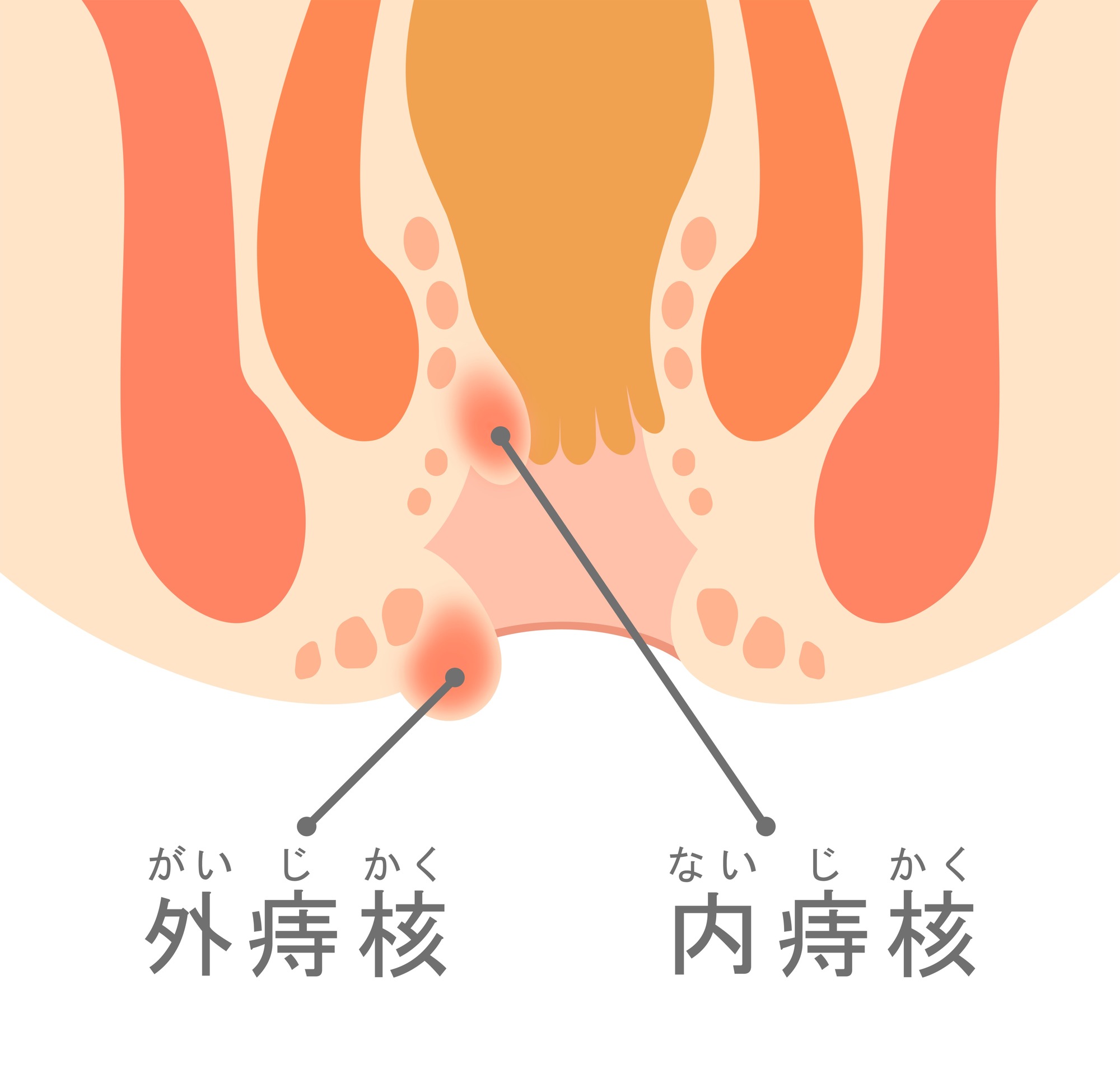 いぼ痔