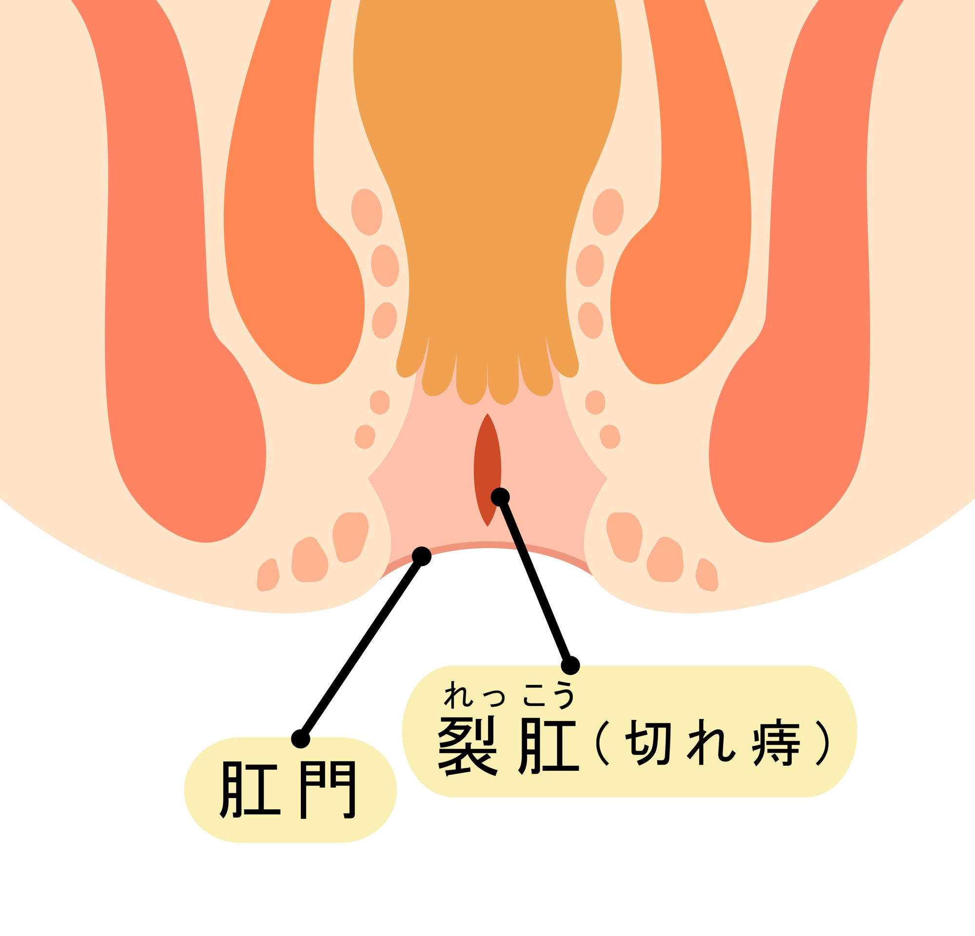 切れ痔