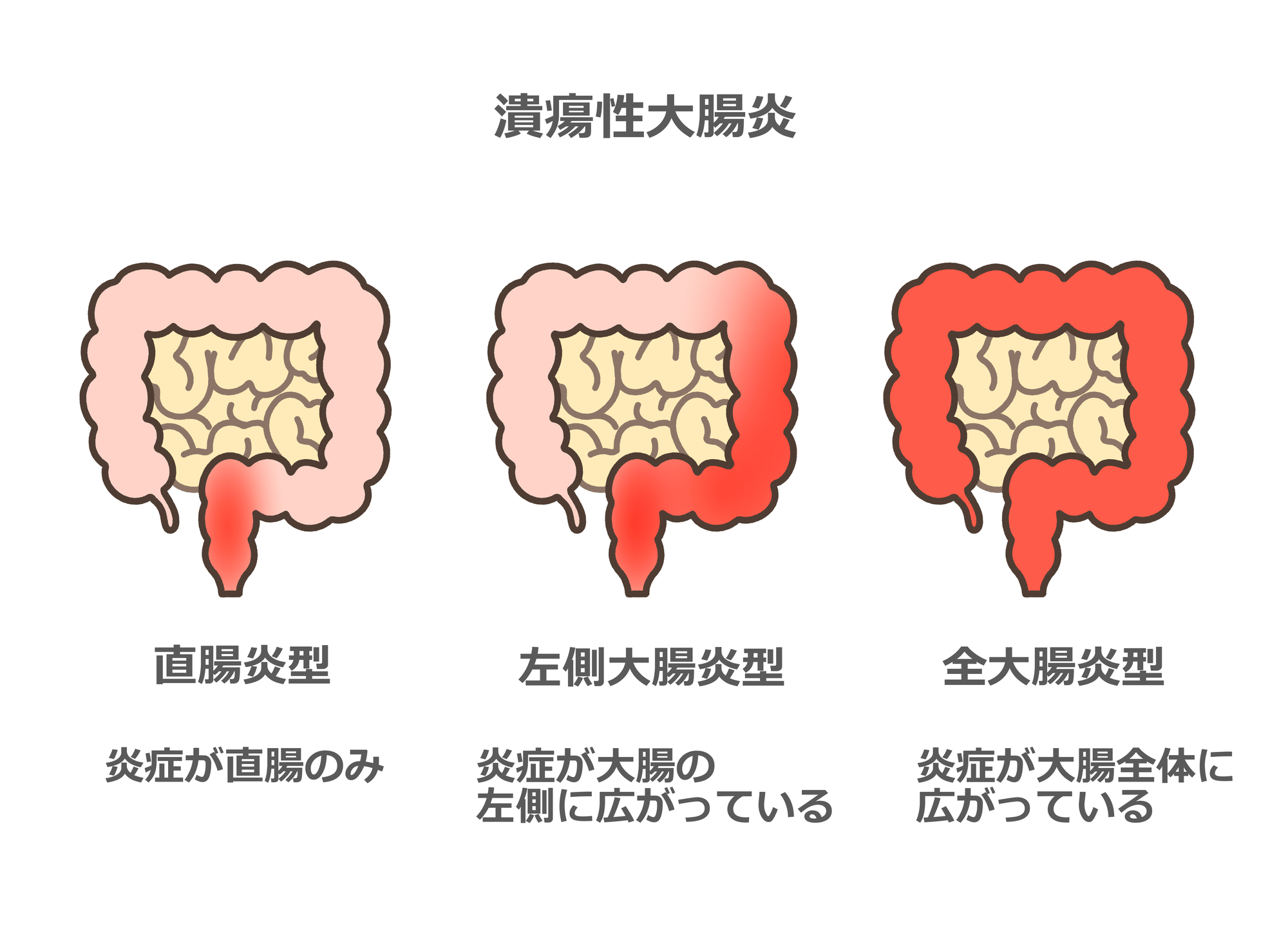 潰瘍性大腸炎